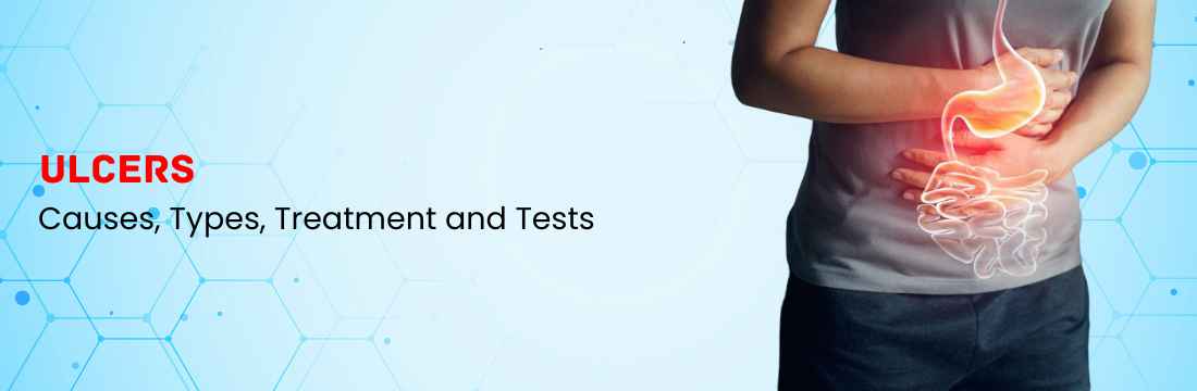 Ulcers: Causes, Types, Treatment and Tests